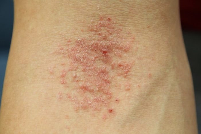 Vùng kín nam giới bị Bong da do Bệnh chàm da eczema